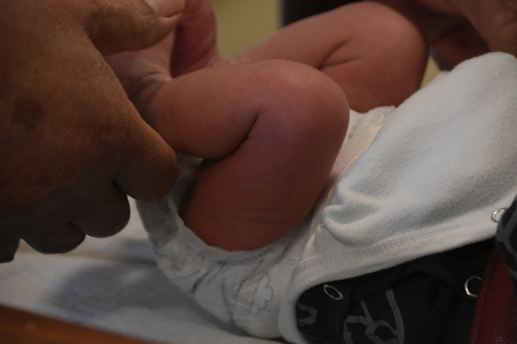 Circumcision: Benefits, Myths, and What to Expect